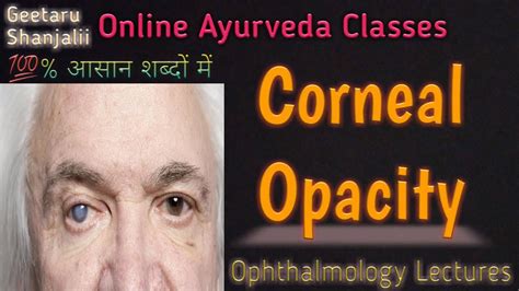 Corneal Opacity By Geetaru Youtube