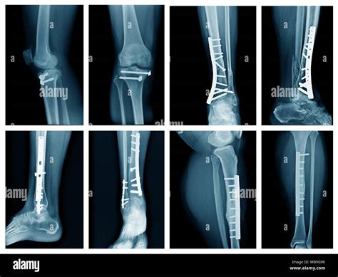 collection leg x-ray with internal fixation, high quality xray leg ...