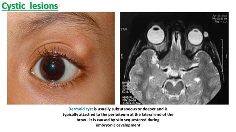 Benign Eyelid Tumors