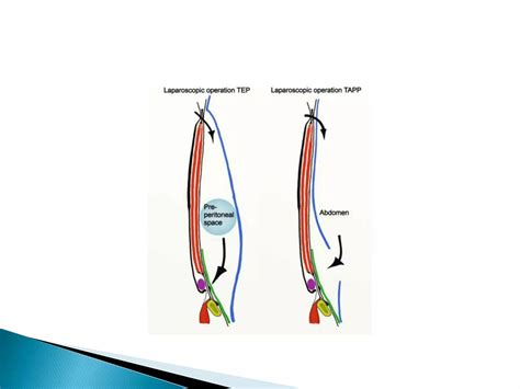 Identifying Cooper's Ligament Open Inguinal Hernia Repair 6