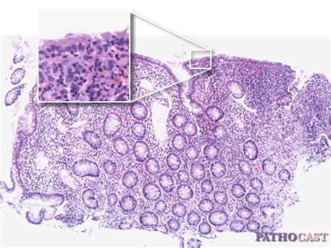 Terminal ileitis in Crohn's disease - DocCheck