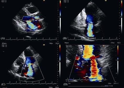 Mitral Valve Echocardiography