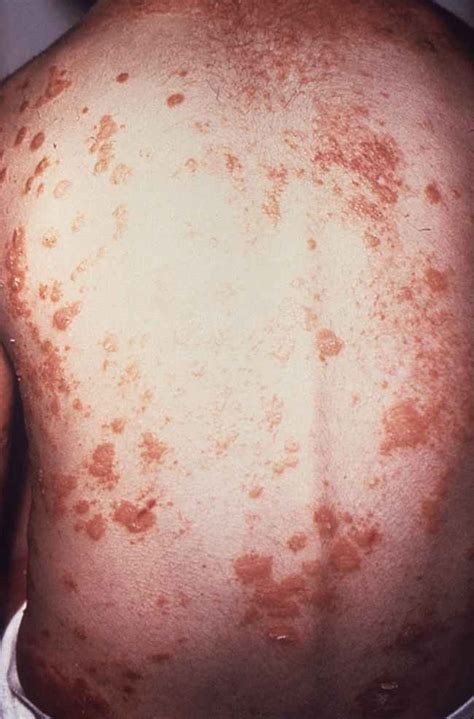 Dermatitis Atopik Patofisiologi Diagnosis Penatalaksanaan Alomedika Themeloader