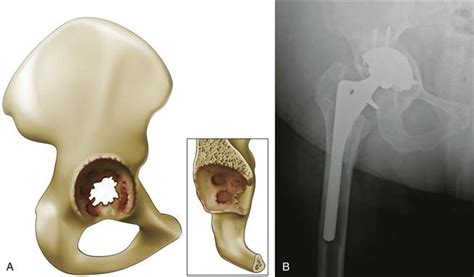 Acetabular Reconstruction Classification Of Bone Defects And Treatment