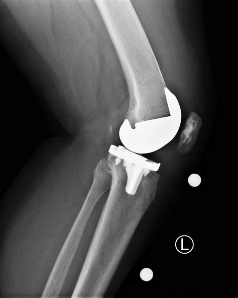 Mako Robotic Arm Assisted Total Knee Arthroplasty Journal Of Medical