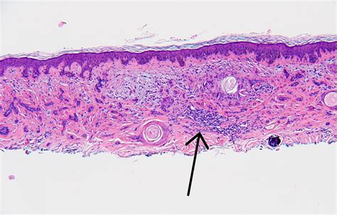 Pathology Outlines Microcystic Adnexal Carcinoma