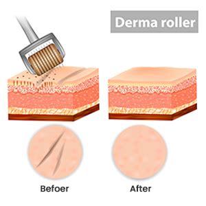 Koi Beauty Derma Roller Mm Real Individual Needles Titanium