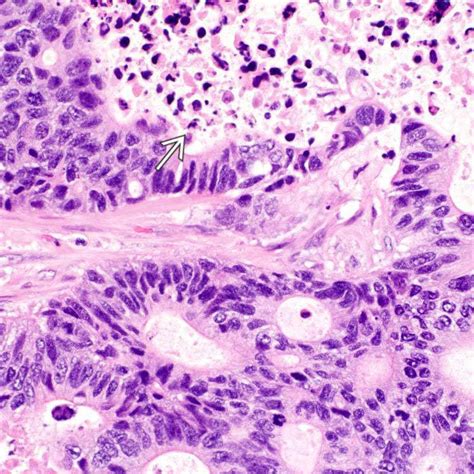 Ampullary Adenocarcinoma And Variants Basicmedical Key