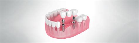 Dental Implants Advantages Risks And Insurance Faqs