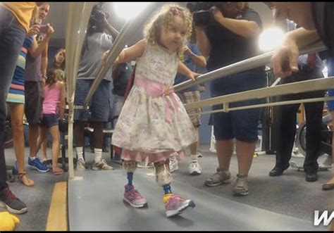 Fla Girl Who Lost Feet In Lawnmower Accident Takes First Steps On Prosthetic Legs Cbs News