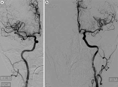 A Angiography Post Stenting Right Common Carotid Artery Rcca Lateral Download Scientific