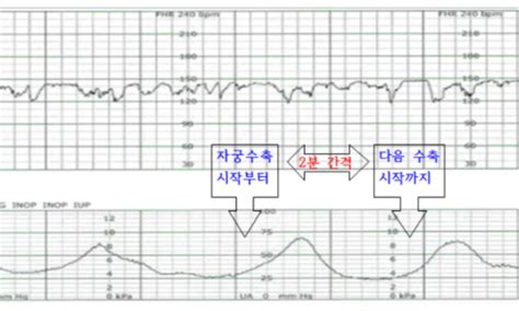 Rn일상공부 Nst Non Stress Test검사 태동검사 비수축검사 비자극검사 방법 그래프읽기 네이버 블로그