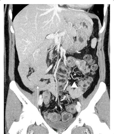 Contrast Enhanced Ct Intestinal Malrotation Maximum Intensity Download Scientific Diagram