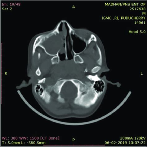 Ct Pns Showing Extensive Mucosal Thickening Within The Right Maxillary Download Scientific