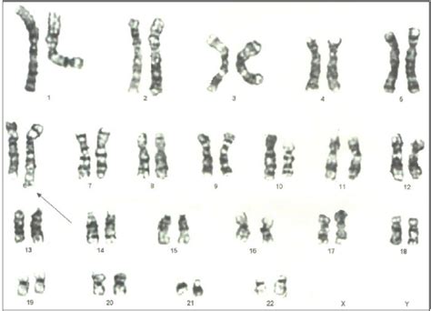 Schematic of the karyotype of a human with Chromosome 6, Partial ...