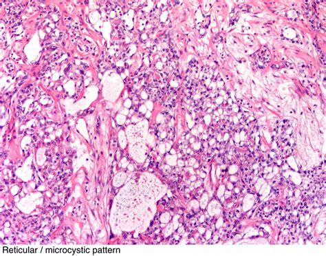 Pathology Outlines Yolk Sac Tumor