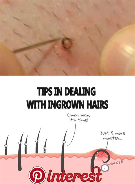 Tips In Dealing With Ingrown Hairs A Gadgets In 2019 Ingrown Hair Remedies Ingrown Hair