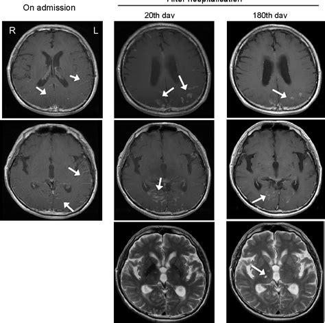 Figure 2 From A Case Of Cryptococcal Meningitis Successfully Treated