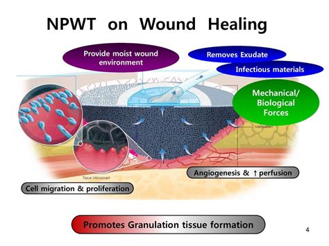 Safe Negative Pressure Wound Therapy The Wound Vac Off