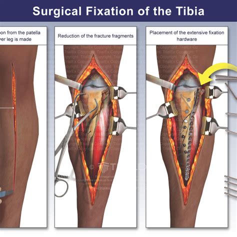 Medical Legal Exhibits Legal Animations Trial Graphics Tria