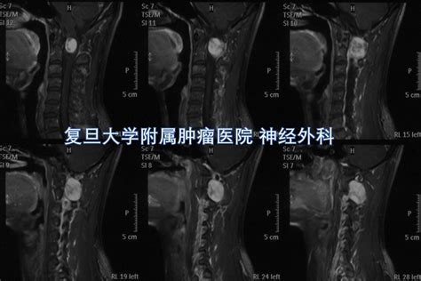 半椎板入路切除高颈段椎管内外沟通性肿瘤 微医（挂号网）