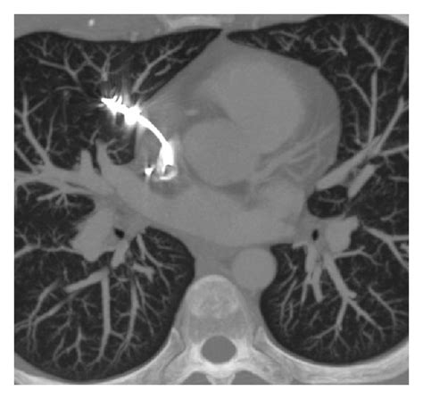 A Postimplant Anteroposterior Chest Radiography Showing The Atrial