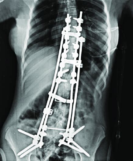 Postoperative Anteroposterior Radiograph Demonstrating That Coronal