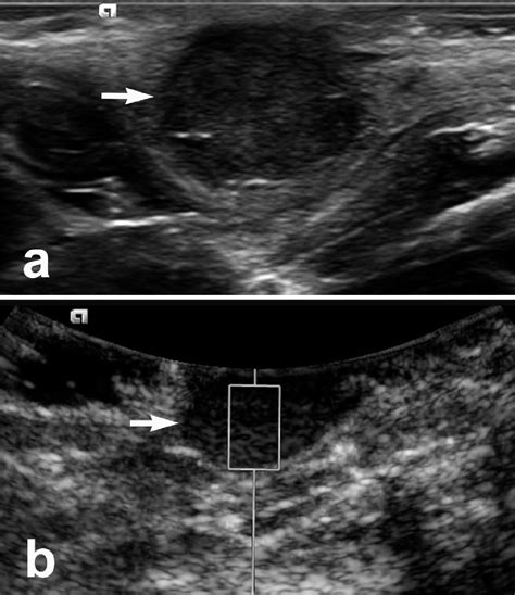 Characteristic Blood Perfusion Reduction Of Walker Tumor Induced By