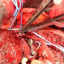 A Hepatocellular Carcinoma Invasion Of The Suprahepatic Inferior Vena