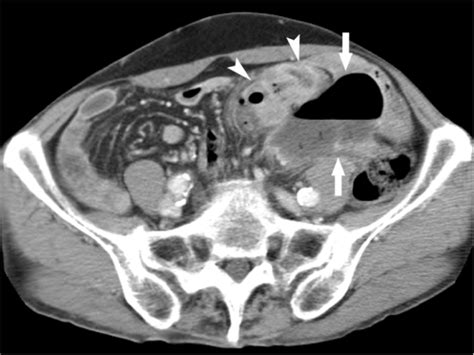 Year Old Man With Perforation Of Sigmoid Colon Trans Open I