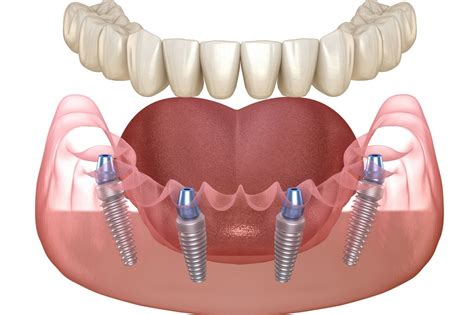 Kiedy Warto Rozwa Y Wstawianie Z B W Na Implantach Blog Karp Med