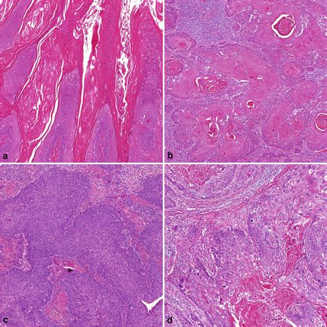 Subtypes Of Penile Squamous Cell Carcinoma Hematoxylin Eosin Stain Download Scientific