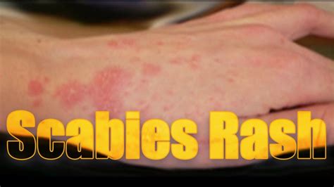 How To Identify Scabies Rash? Scabies Rash, Scabies, Skin Rashes ...