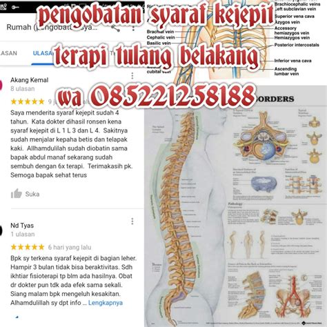 Mengenali Gejala Syaraf Kejepit Hnp Dan Efeknya By Ahli Pijat Syaraf