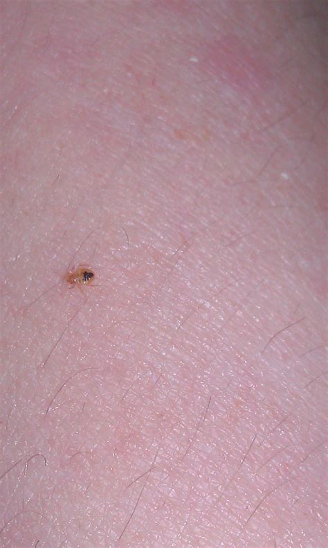 Baby Bed Bugs Bites