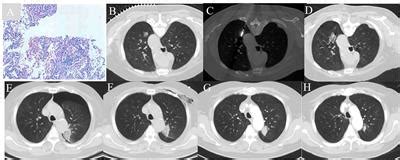 Frontiers Cost And Effectiveness Of Microwave Ablation Versus Video