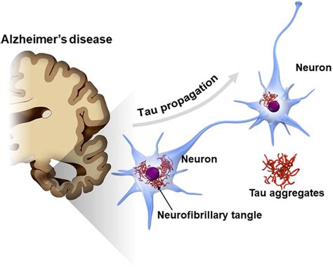 Neurofibrillary Tangles