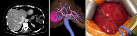 A Hybrid Method Of Laparoscopic Assisted Open Liver Resection Through A