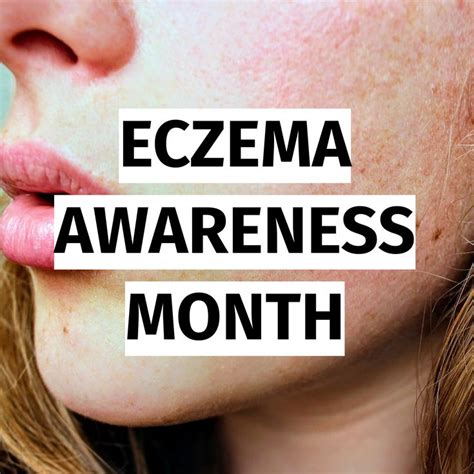 October Is Eczema Awareness Month In 2022 Awareness Month Awareness Eczema