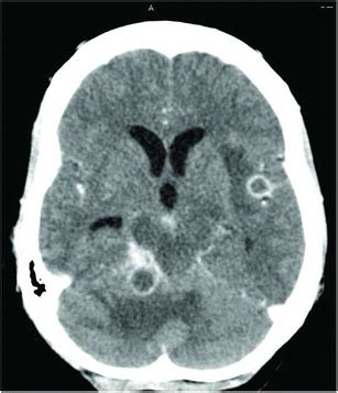 Contrast Enhanced Axial Computed Tomography CT Image Of TBM IRIS CT