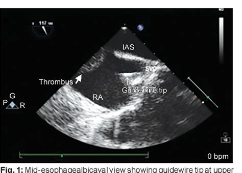 Figure From A Rare Case Report Of Intravenous Leiomyomatosis With