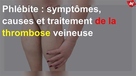 Phlébite symptômes causes et traitement de la thrombose veineuse