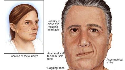 Bells Palsy Berhubungan Dengan Saraf Sebabkan Kelumpuhan Satu Sisi