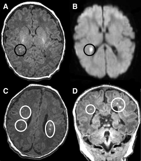 Pvl Mri - Periventricular Leukomalacia Pvl Grades Determined On The Basis Of Download Scientific ...