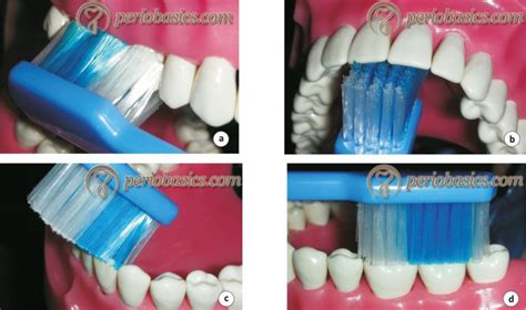 Tooth-brushing techniques - periobasics.com