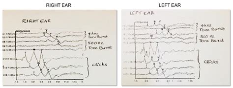 Auditory Brainstem Response ABR Showing Bilateral Presence Of Waves