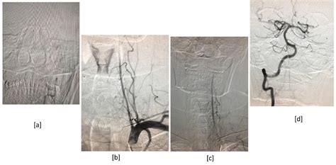 A B C DSA Revealing Progressive Smooth Tapering Of The Distal