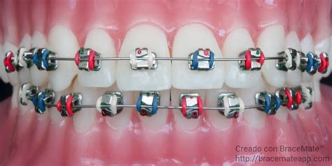 12 Braces Colors Ideas to Stand Out! – Somos Dental