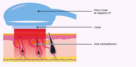 Tarifs De Lépilation Laser Définitive à Toulouse Dr Germain