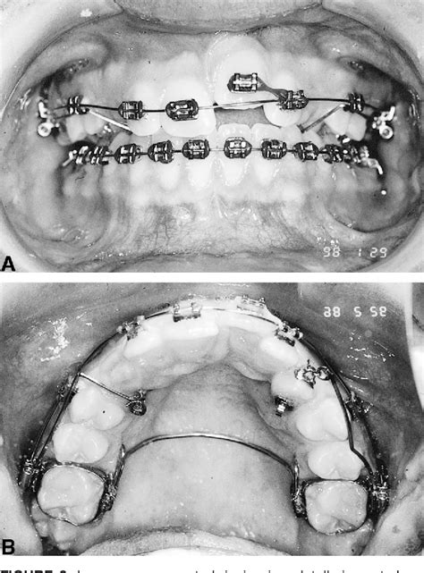 Figure 2 From Moving An Ankylosed Central Incisor Using Orthodontics Surgery And Distraction